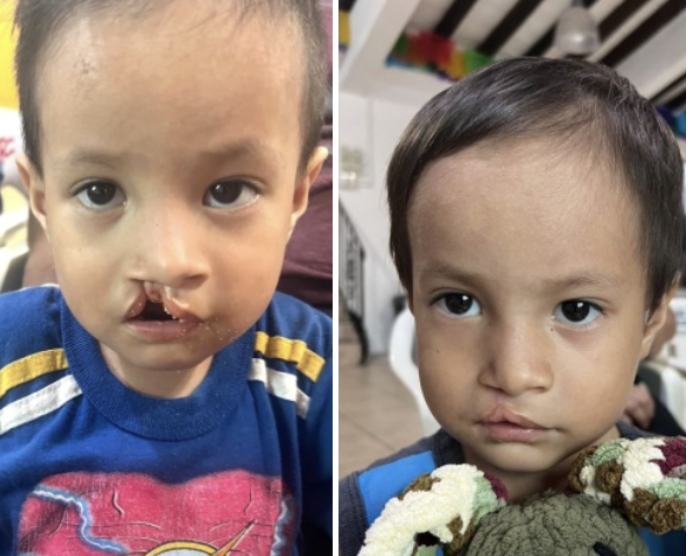 Cleft_before_after_boy.png