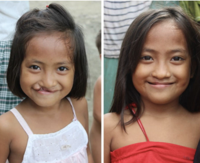Cleft_before_after_girl.png